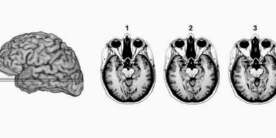 Picture According To Science, You Will Be Fearless If You Remove This Part Of Your Brain