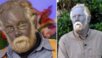 Picture 15 Bizarre Medical Conditions That Sound Too Insane to be True