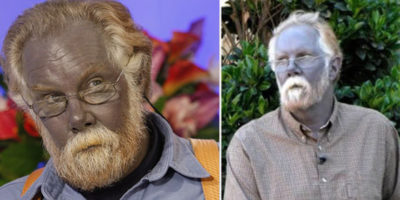Picture 15 Bizarre Medical Conditions That Sound Too Insane to be True