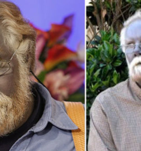 Picture 15 Bizarre Medical Conditions That Sound Too Insane to be True