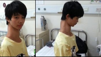 Picture This Chinese Kid With An Unusually Long Neck Is Suffering From Rare Spinal Deformity