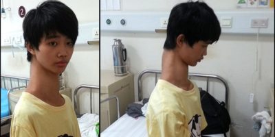 Picture This Chinese Kid With An Unusually Long Neck Is Suffering From Rare Spinal Deformity