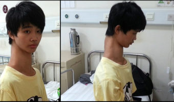 Picture This Chinese Kid With An Unusually Long Neck Is Suffering From Rare Spinal Deformity