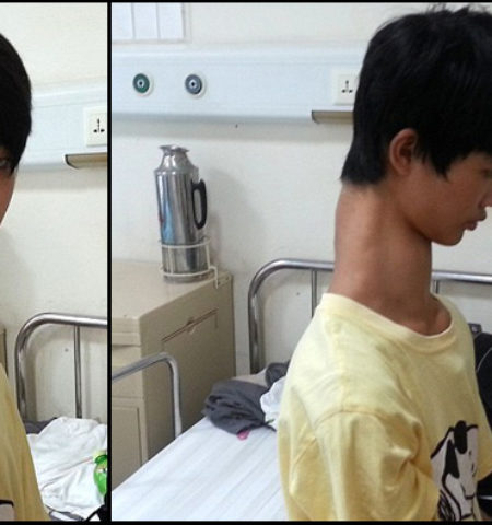 Picture This Chinese Kid With An Unusually Long Neck Is Suffering From Rare Spinal Deformity