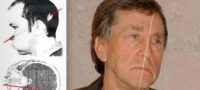 Picture The Two Faced Man: Particle Accelerator Keeps One Half Of A Man’s Face Young & Wrinkle Free