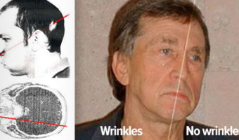 Picture The Two Faced Man: Particle Accelerator Keeps One Half Of A Man’s Face Young & Wrinkle Free