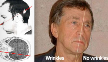 Picture The Two Faced Man: Particle Accelerator Keeps One Half Of A Man’s Face Young & Wrinkle Free