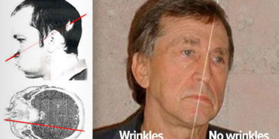 Picture The Two Faced Man: Particle Accelerator Keeps One Half Of A Man’s Face Young & Wrinkle Free