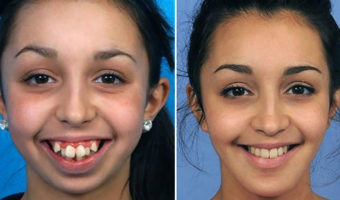 Picture Remarkable pictures of a woman after a jaw surgery – that has changed her life forever.