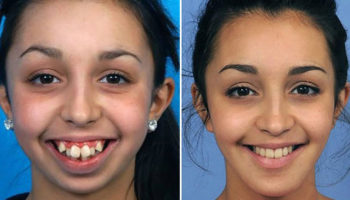 Picture Remarkable pictures of a woman after a jaw surgery – that has changed her life forever