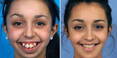 Picture Remarkable pictures of a woman after a jaw surgery – that has changed her life forever