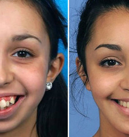 Picture Remarkable pictures of a woman after a jaw surgery – that has changed her life forever