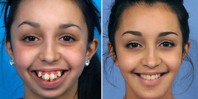 Remarkable Jaw Surgery