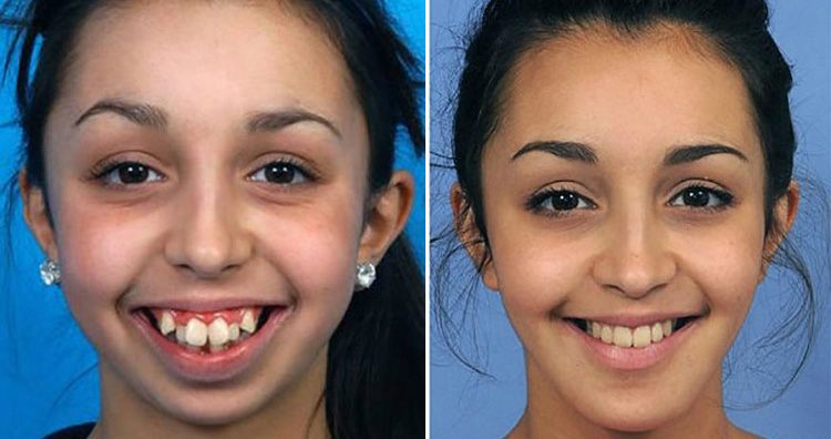 Remarkable Jaw Surgery