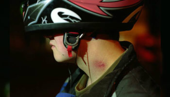 Picture A Mexican Teen Dies After Receiving a Love Bite From His Girlfriend