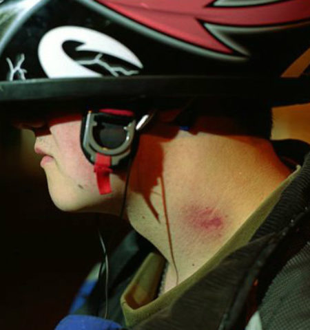 Picture A Mexican Teen Dies After Receiving a Love Bite From His Girlfriend