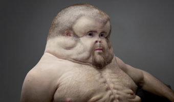 Picture Meet Graham – The Super Human With Massive Head & Extra Nipples, One Who Can Survive High Speed Car Crash