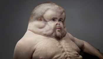 Picture Meet Graham – The Super Human With Massive Head & Extra Nipples, One Who Can Survive High Speed Car Crash