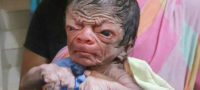Picture Baby Boy from Bangladesh with Progeria Looks Like an 80-Year-Old