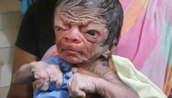 Picture Baby Boy from Bangladesh with Progeria Looks Like an 80-Year-Old