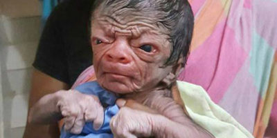 Picture Baby Boy from Bangladesh with Progeria Looks Like an 80-Year-Old