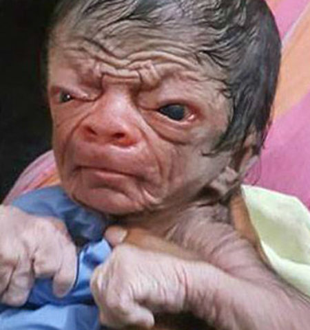 Picture Baby Boy from Bangladesh with Progeria Looks Like an 80-Year-Old