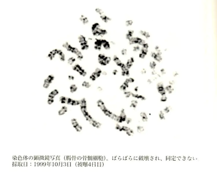Ouchi's Damaged Chromosomes After Tokaimura Nuclear Accident, 1999