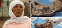 Picture A Woman Had Carried a Baby in Her Womb for 46 Years and Then Gave Birth to a “Stone baby”