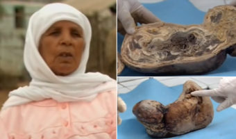 Picture A Woman Had Carried a Baby in Her Womb for 46 Years and Then Gave Birth to a “Stone baby”