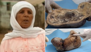 Picture A Woman Had Carried a Baby in Her Womb for 46 Years and Then Gave Birth to a “Stone baby”