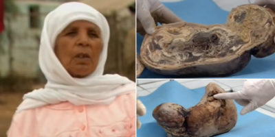 Picture A Woman Had Carried a Baby in Her Womb for 46 Years and Then Gave Birth to a “Stone baby”