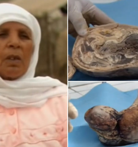 Picture A Woman Had Carried a Baby in Her Womb for 46 Years and Then Gave Birth to a “Stone baby”