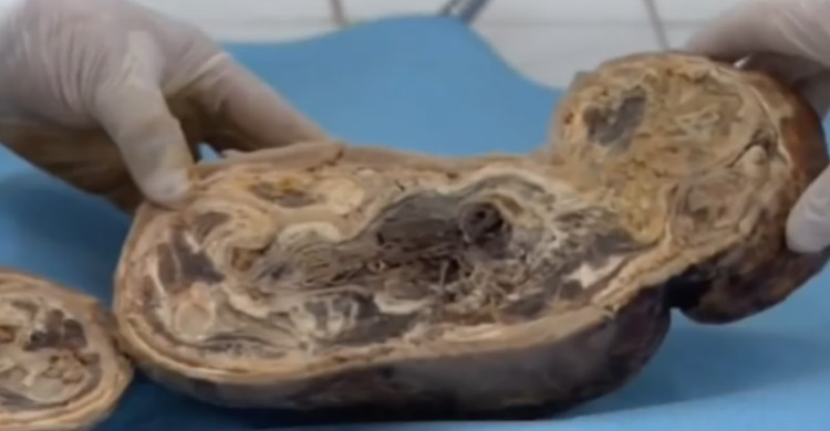 A Moroccan woman gives birth to a "stone baby" after 46 year pregnancy