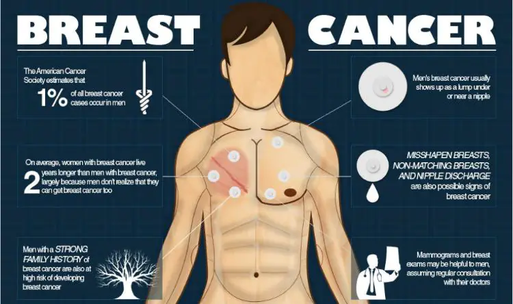 Breast cancer in men