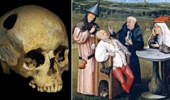 Picture 13 Bizarre Historical Medical Treatments