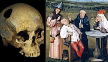 Picture 13 Bizarre Historical Medical Treatments