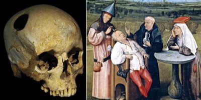 Picture 13 Bizarre Historical Medical Treatments