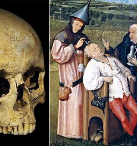 Picture 13 Bizarre Historical Medical Treatments