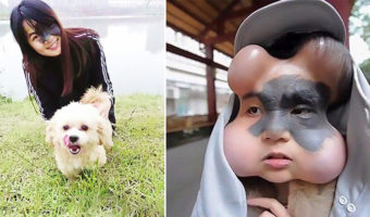 Picture Chinese Woman had Four Balloons Implanted in her Face to Treat a Birthmark