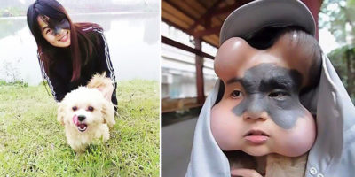 Picture Chinese Woman had Four Balloons Implanted in her Face to Treat a Birthmark