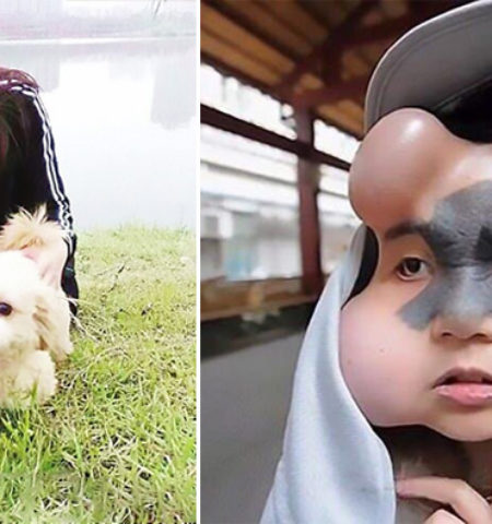 Picture Chinese Woman had Four Balloons Implanted in her Face to Treat a Birthmark