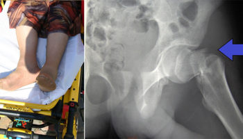 Picture 10 Everyday Activities Likely to Cause Serious Injuries