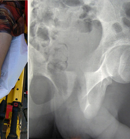 Picture 10 Everyday Activities Likely to Cause Serious Injuries