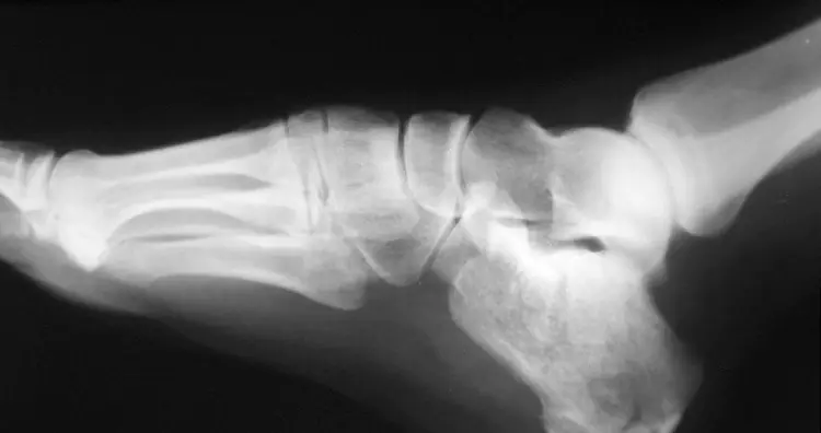 How strong are your bones?