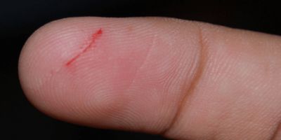 Picture Why Does a Paper Cut Hurt so Much?