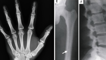 Picture How a Car Accident Led to the Discovery of the World’s Densest Bones, Which Are Practically Immune to Fracture