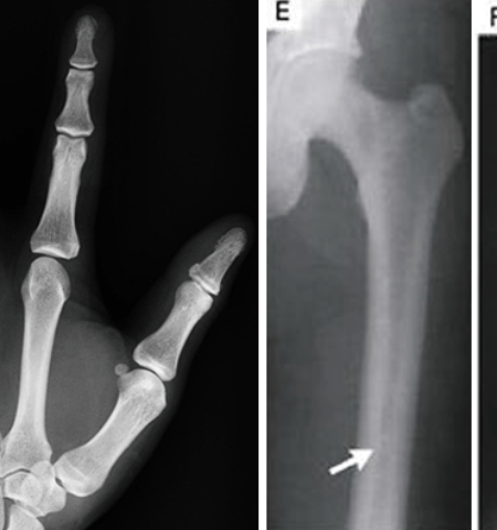 Picture How a Car Accident Led to the Discovery of the World’s Densest Bones, Which Are Practically Immune to Fracture