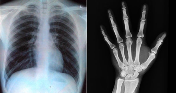 This Gene Mutation Causes Abnormally Dense Bones that Never Fracture