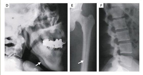 this-gene-mutation-causes-abnormally-dense-bones-that-never-fracture