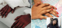 Picture Woman Amputee’s Transplanted “Male Hands” Turn Feminine, Stuns the Experts